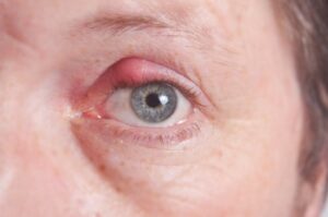 Sty Eyelid sty