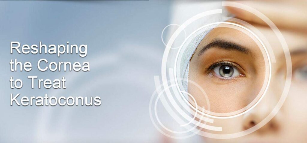 reshaping-the-cornea