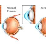 Keratoconus treatment in Los Angeles