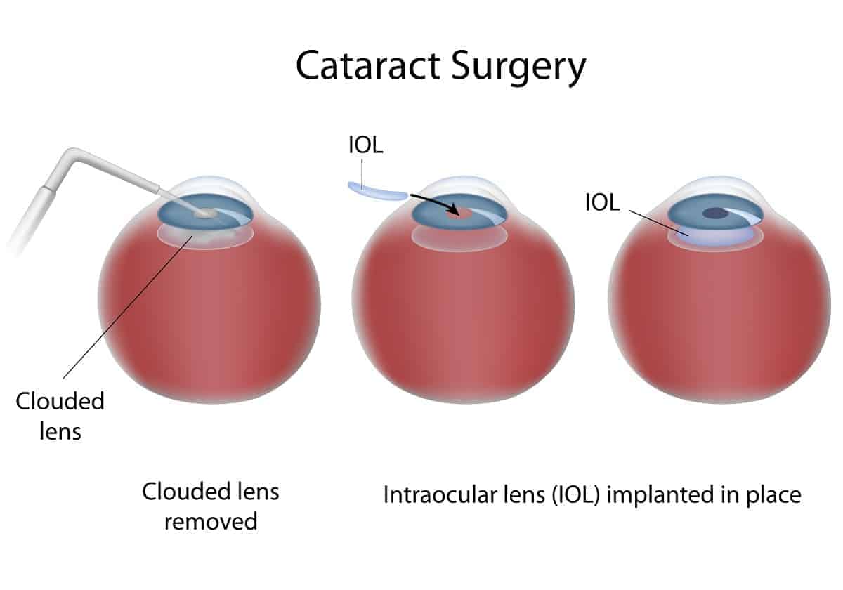 Which Intraocular Lens Is Right for You? 1 Intraocular lens Los Angeles