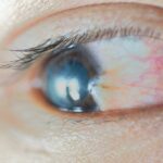 Can pterygium reoccur after removal?