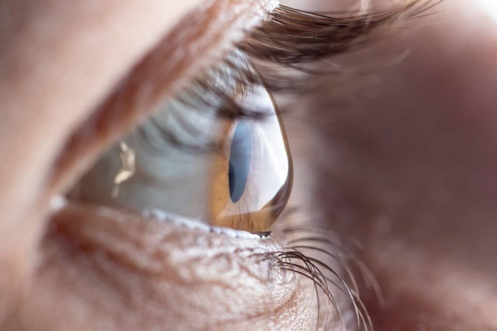 Advice for Those Recently Diagnosed With Keratoconus 1 Keratoconus Example