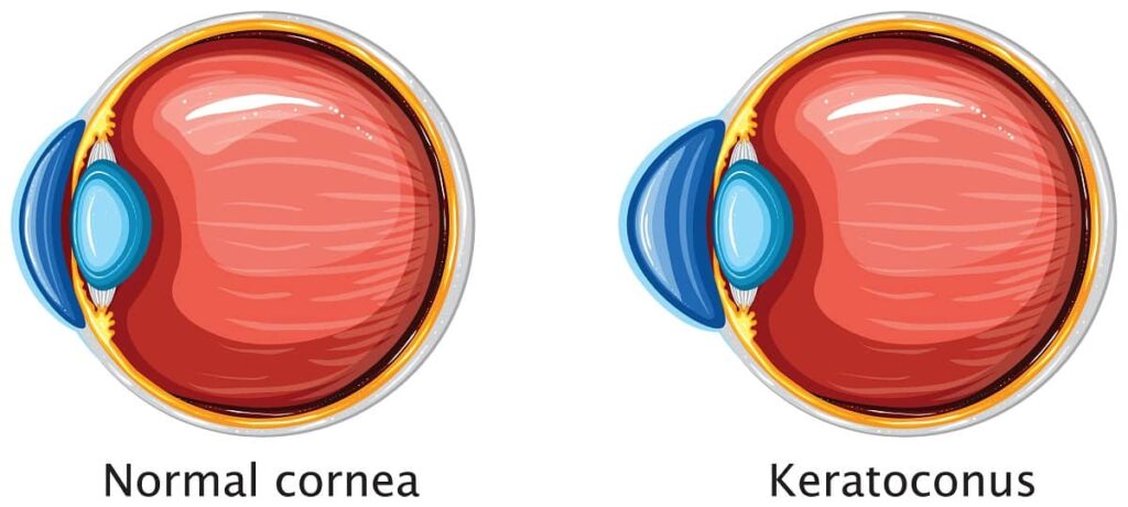 Corneal Crosslinking Benefits That May Surprise You 1 Cornea Affected by Keratoconus Infographic