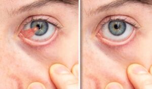 Pterygium Removal Technique & Cost 1 Extirpación de carnosidad Los Ángeles