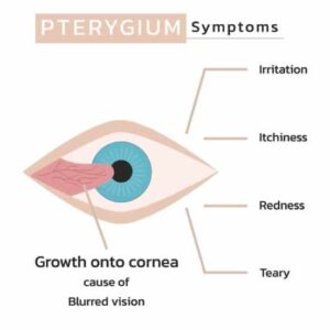 Pterygium Removal Technique & Cost 2 Técnicas de eliminación de carnosidad Los Ángeles