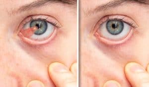 Pterygium Removal & Surgery Los Angeles - Laser Eye Center