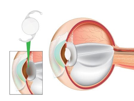 Advanced, New Technology for Cataract Surgery in Los Angeles 3 Cataract surgeon in LA