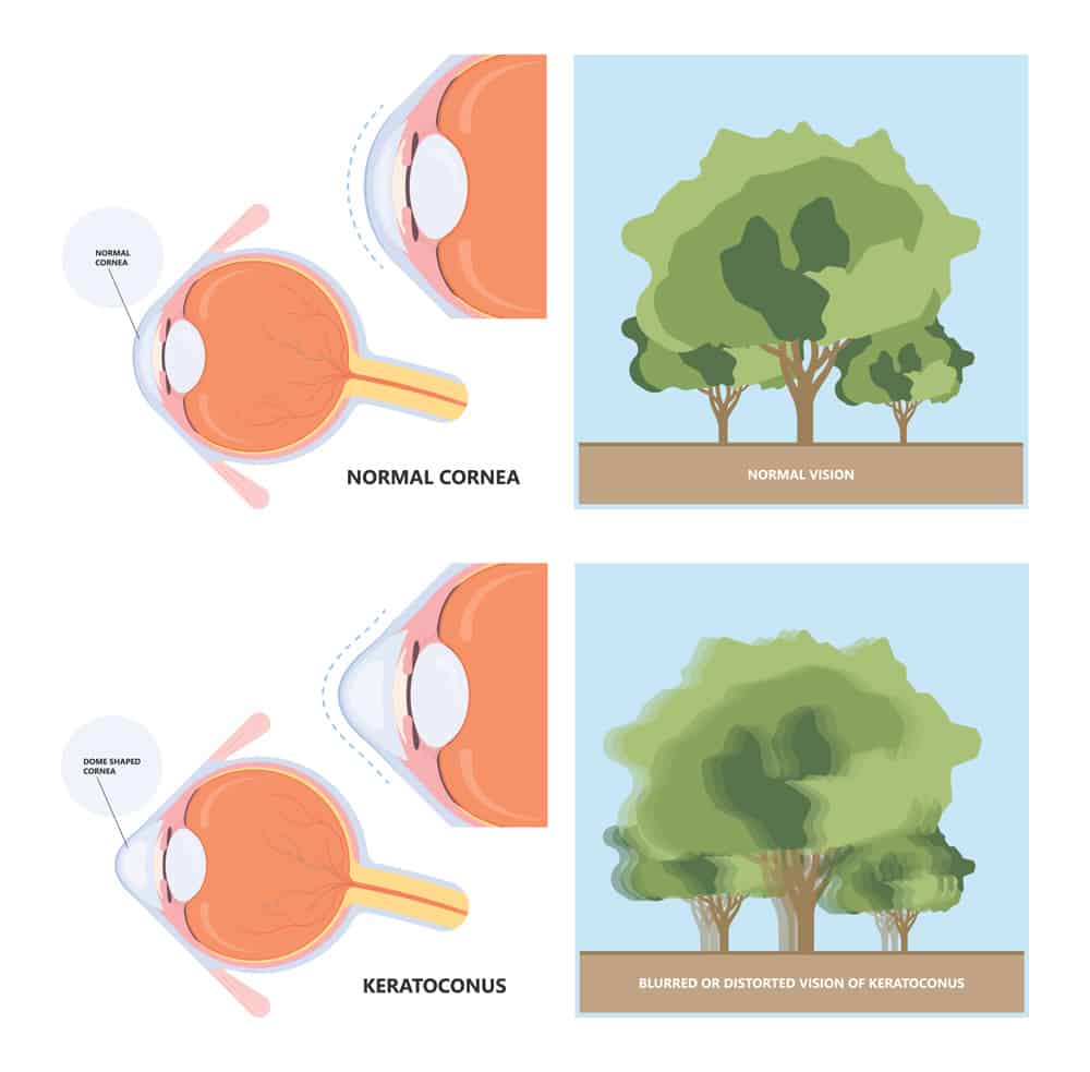 Corneal Cross-Linking 3 Los Angeles keratoconus treatment