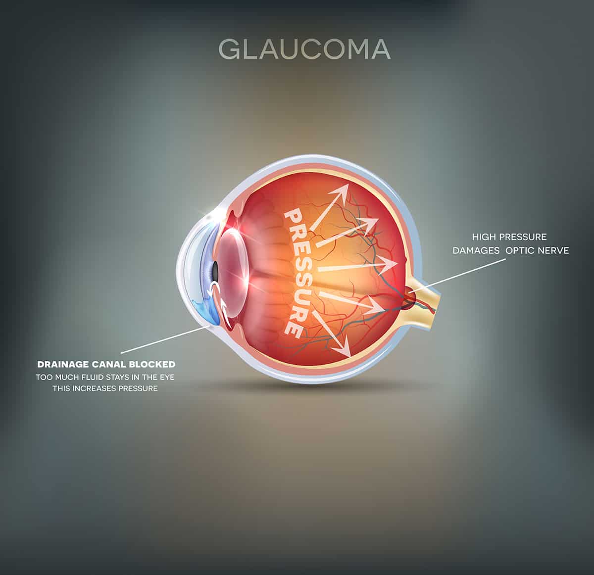 Glaucoma versus Cataracts Riverside