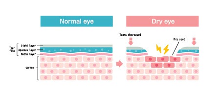 New Treatments for Dry Eyes in 2025 2 dry eye disease treatment 2023 Los Angeles